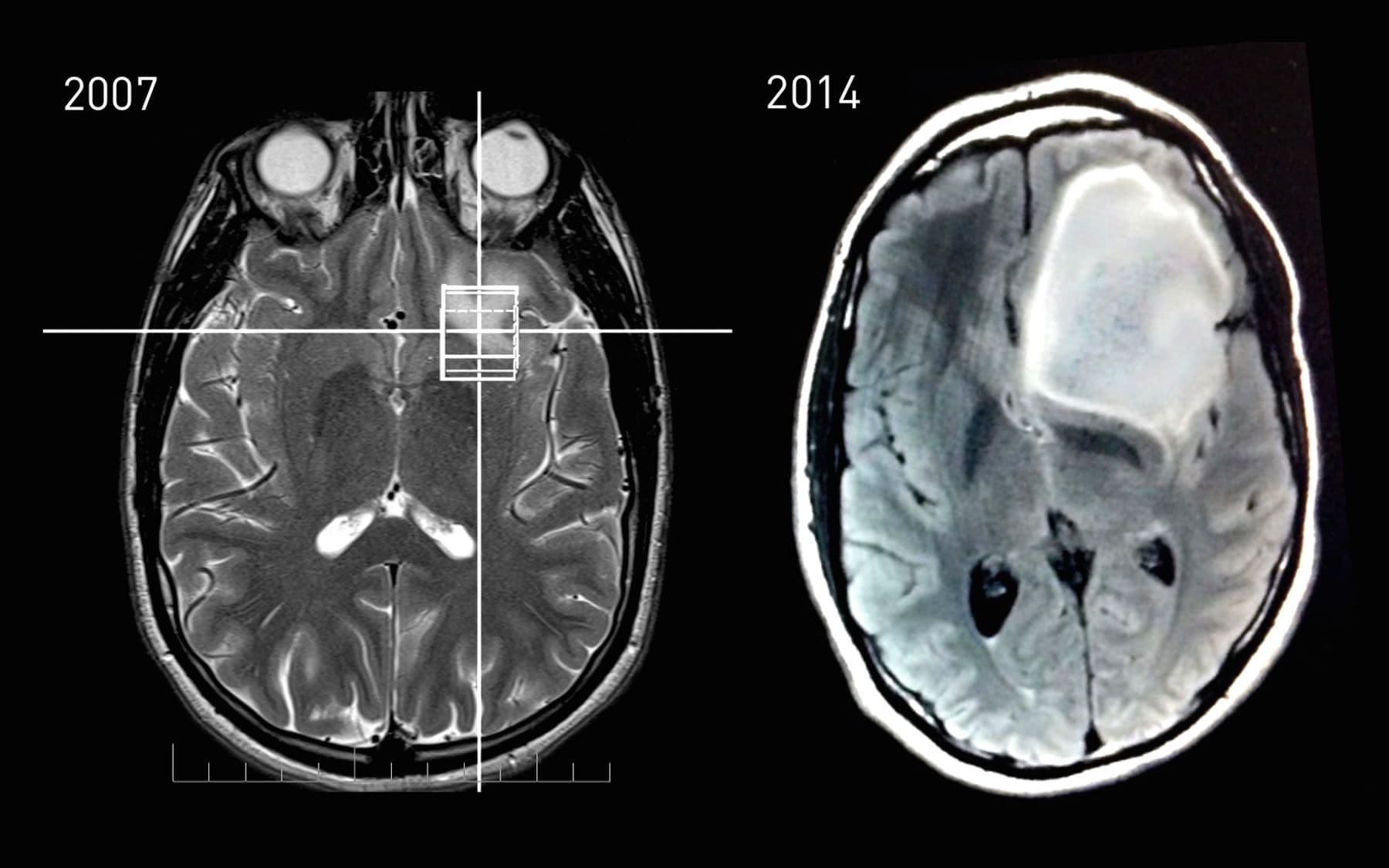Axial brain MRI scans from 2007 and 2014